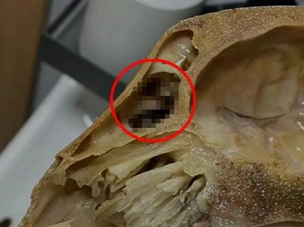 钻石配资 外卖吃完发现全是蛆！判赔1000元！男子上吐下泻险瘫痪，就医时发现患“怪病”…